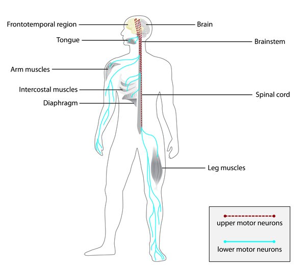 motor neurone disease